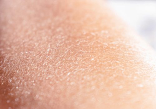 Itchy, Dry Skin