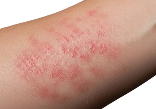 Red rashes